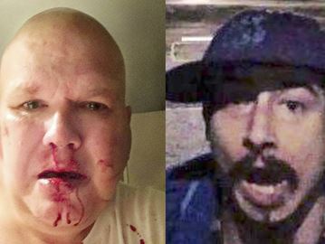 Gregory Hewitt, left, was allegedly assaulted by a man on Kingswood Road, just above Bracken Avenue. His Facebook post with a photo of his bloodied face along with a photo he’d snapped of the suspect, helped to locate the man.
