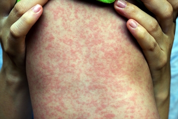measles_Content.jpg
