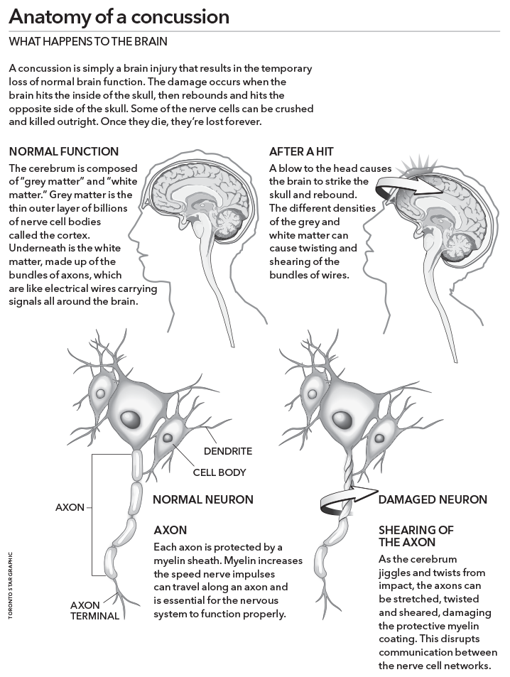 Graphic: Anatomy of a concussion